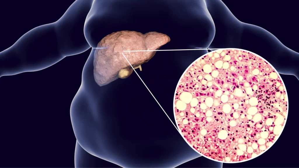 Healthy liver after using a natural supplement to burn liver fat